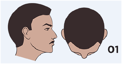 Understanding the Male Pattern Hair Loss Stages