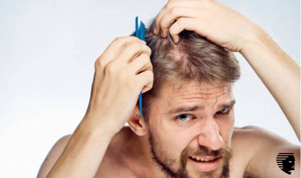  pérdida de cabello en hombres 