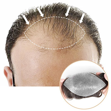 Heavy receding hairline patch