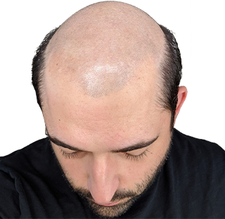 Male Pattern Baldness