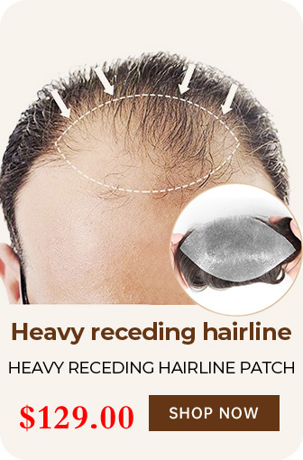 HEAVY RECEDING HAIRLINE PATCH